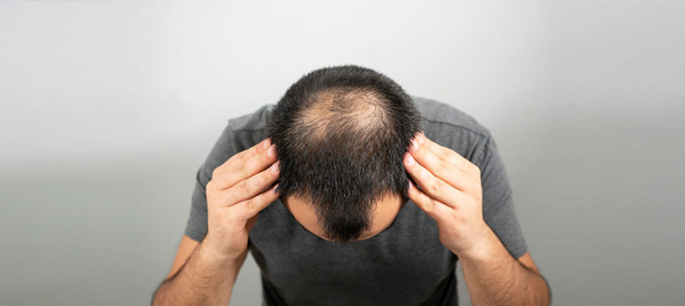 Alopecia areata treatment in Kerala