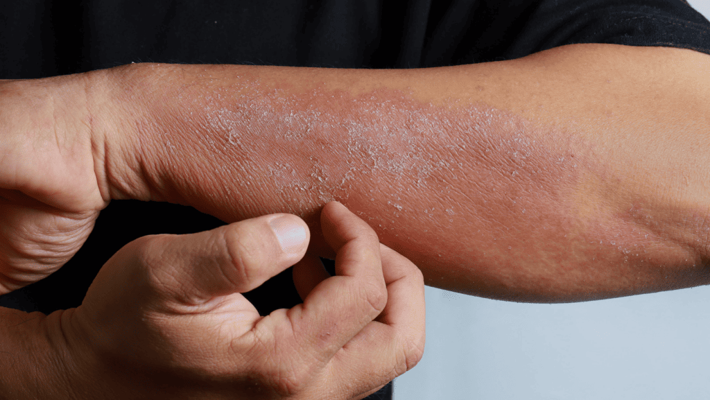 Seborrheic Dermatitis Raleigh Nc