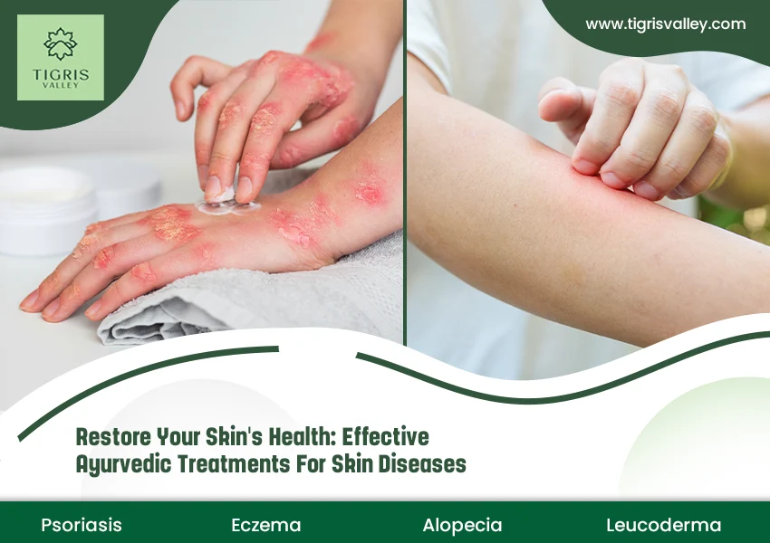 Restore Your Skin’s Health: Effective Ayurvedic Treatments for Skin Diseases