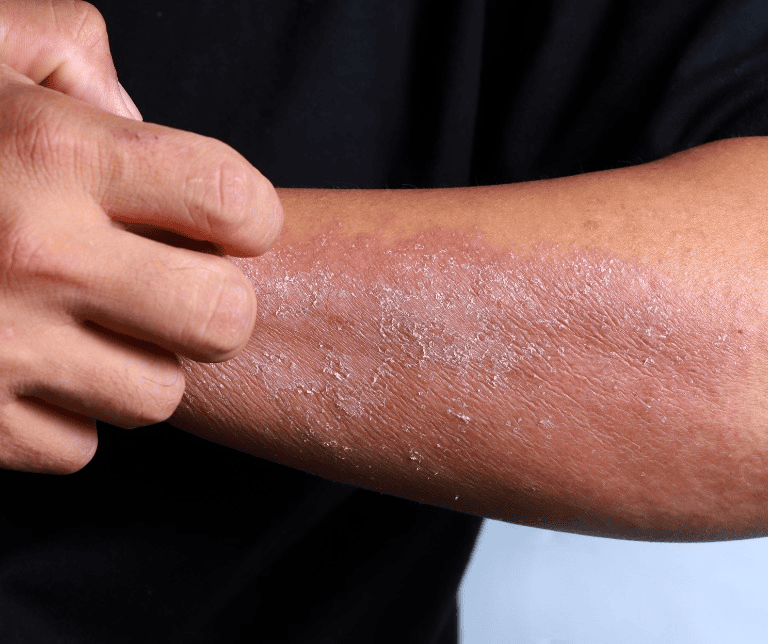 psoriasis ayurvedic treatment in india 