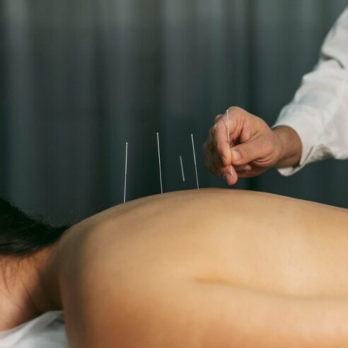 acupuncture treatment