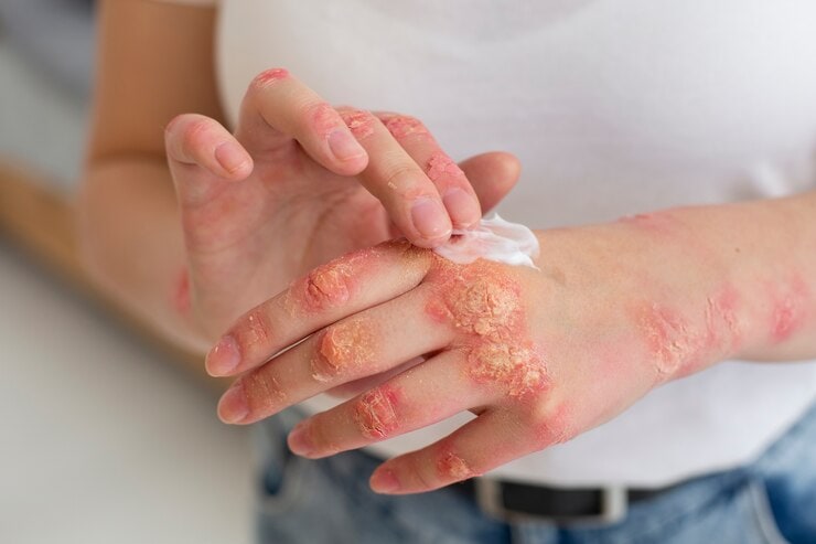 psoriasis treatment in kerala