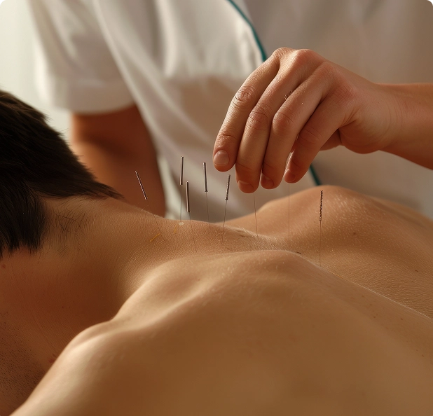 Acupuncture treatment for pain relief and holistic wellness at Tigris Valley